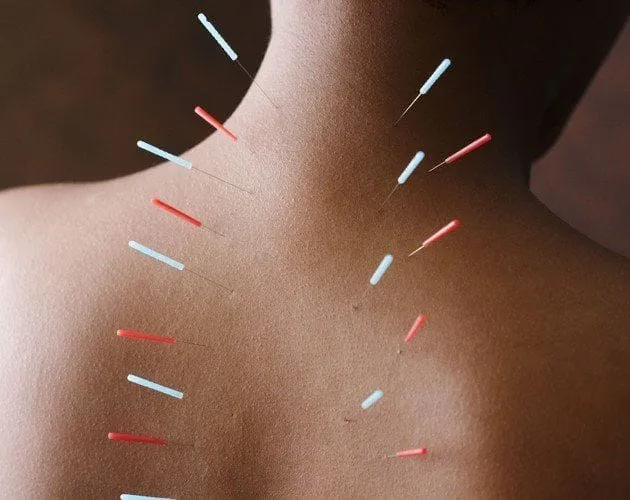 Acupuncture