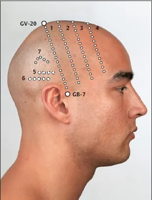 Scalp Acupuncture